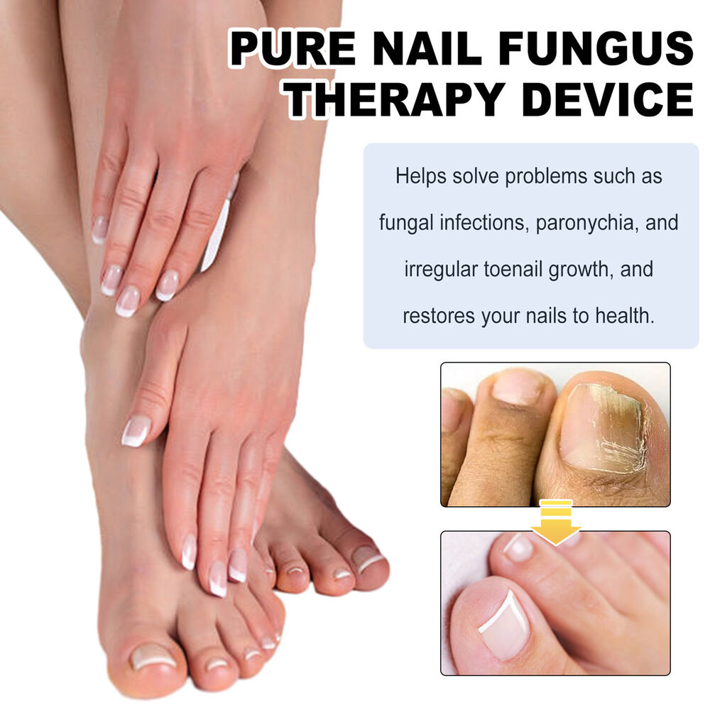 Nail Fungus Laser Device Light Therapy Onychomycosis Toes Treatment 910nm Home