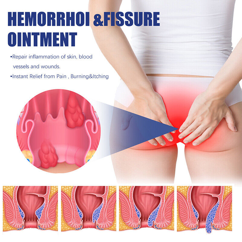 3 Hemorrhoid & Fissure Ointment Hemorrhoid Treatment