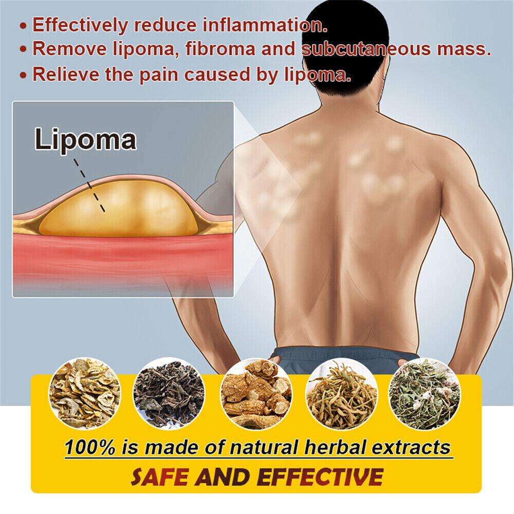 Lipoma Removal Cream Treatment Skin Swelling Ointment Exfoliating Pain Relief`