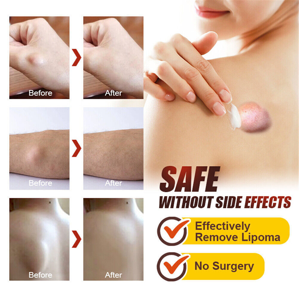 Lipoma Removal Cream Treatment Skin Swelling Ointment Exfoliating Pain Relief`