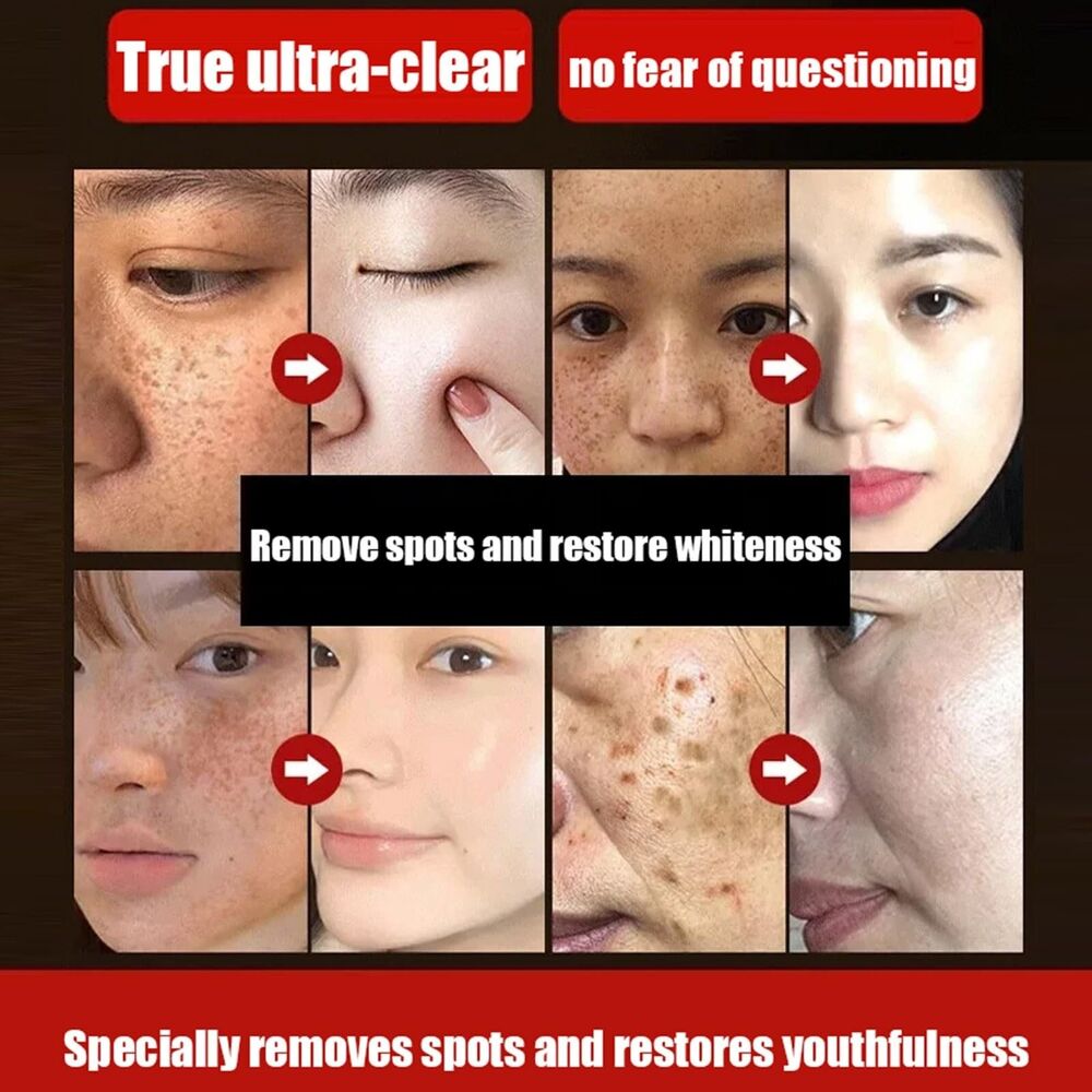 2x Anti-Blemish Ageing Wrinkle Tear-Off Mask Freckle Removal Sleep Face Beauty Mask