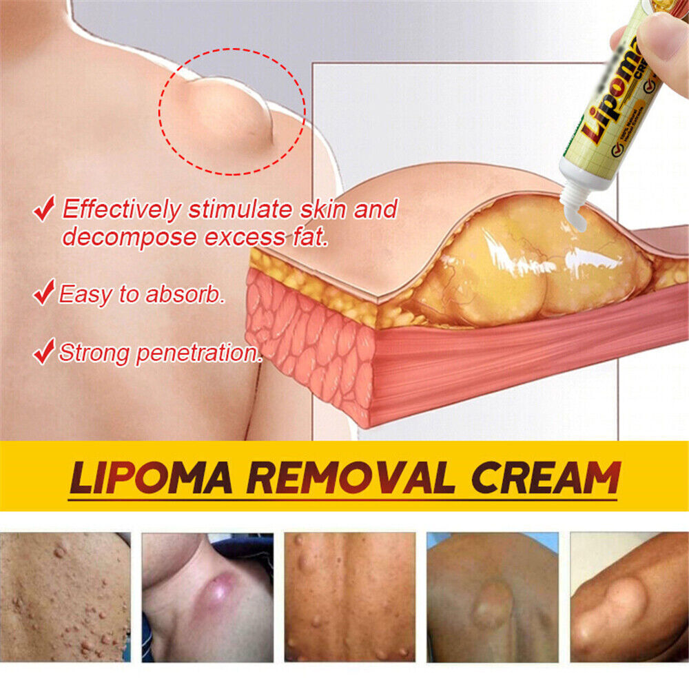 Lipoma Removal Cream Treatment Skin Swelling Ointment Exfoliating Pain Relief`