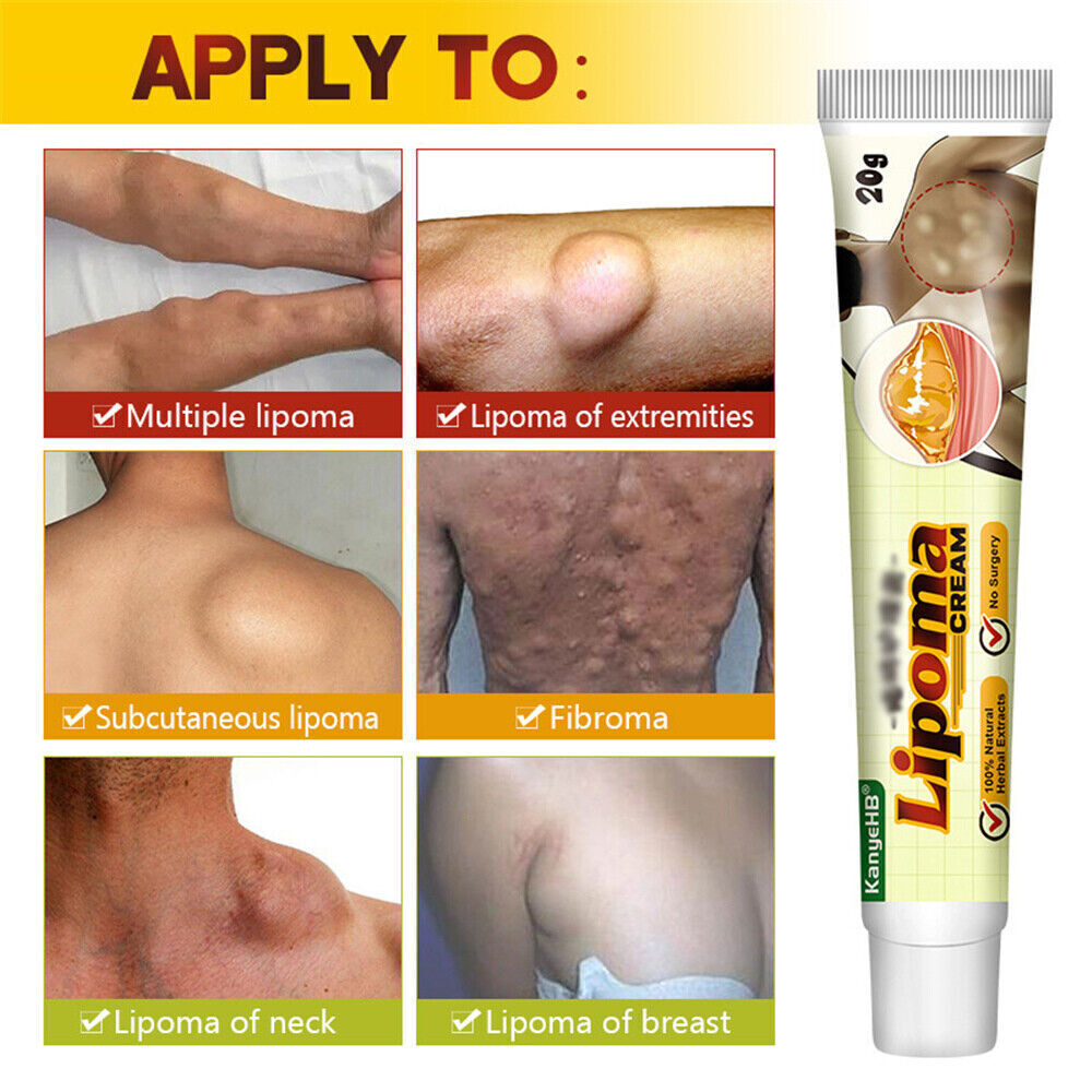 Lipoma Removal Cream Treatment Skin Swelling Ointment Exfoliating Pain Relief`