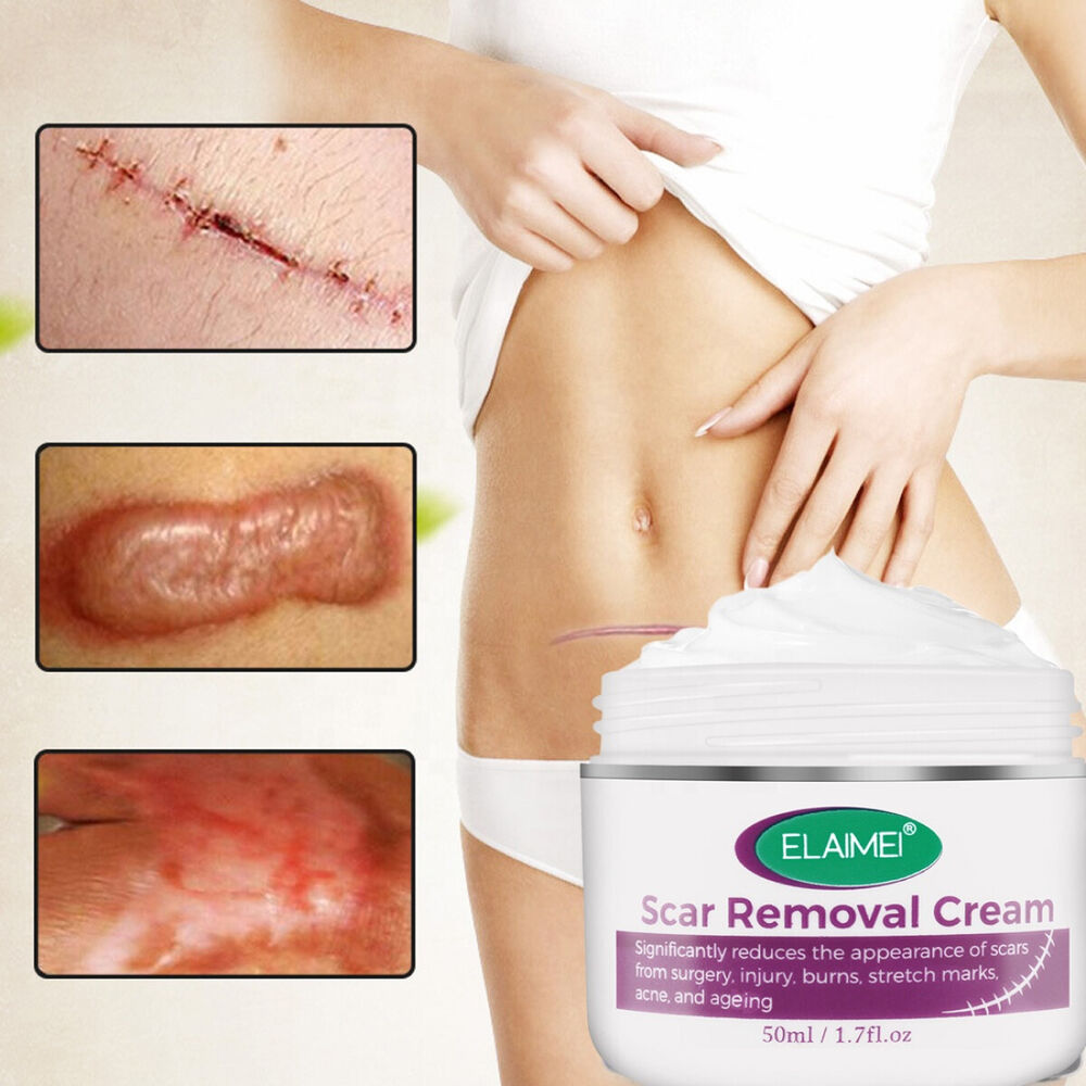 Scar Removal Treatment Cream Stretch Marks Skin Repair Advanced Face Body Heal