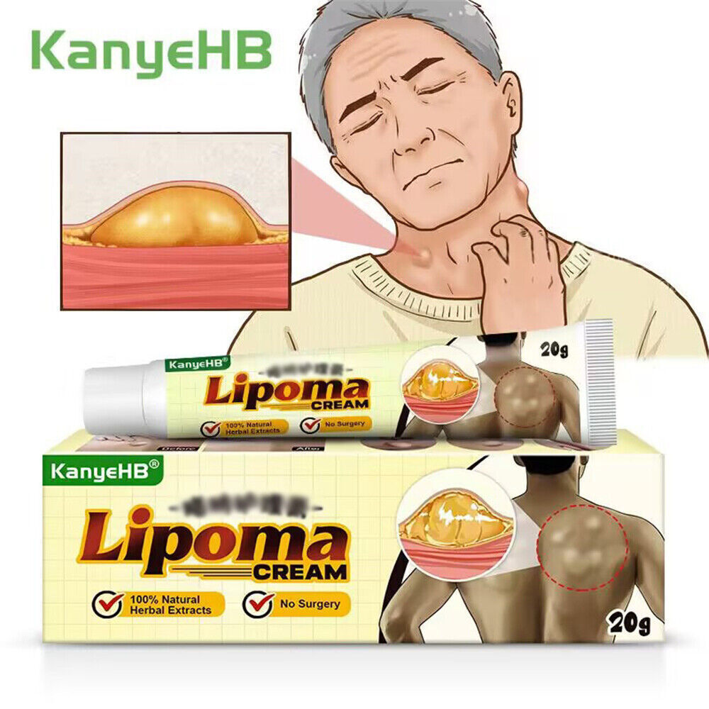 Lipoma Removal Cream Treatment Skin Swelling Ointment Exfoliating Pain Relief`