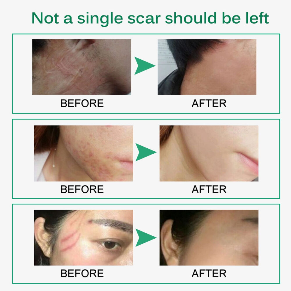 Scar Removal Treatment Cream Stretch Marks Skin Repair Advanced Face Body Heal