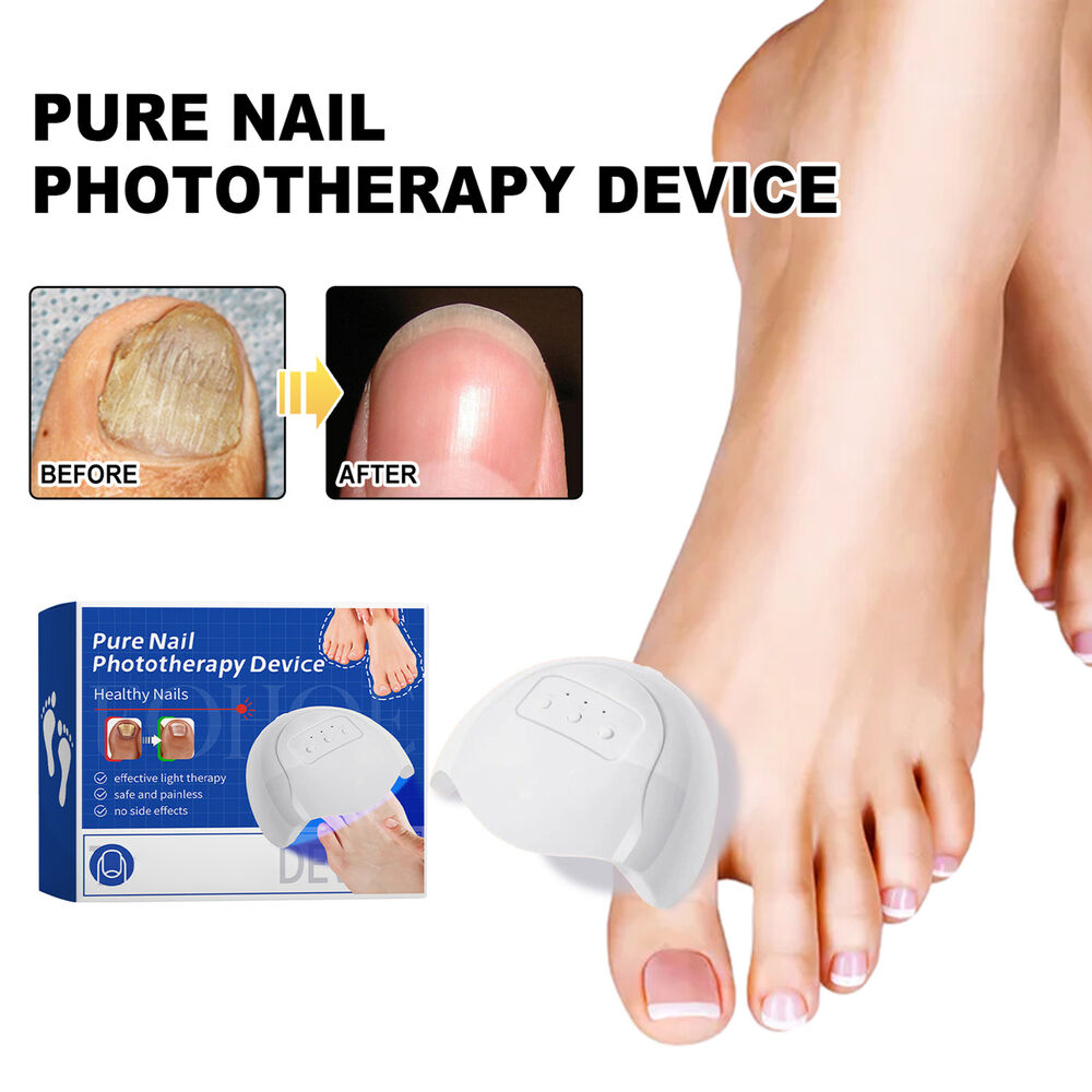 Nail Fungus Laser Device Light Therapy Onychomycosis Toes Treatment 910nm Home