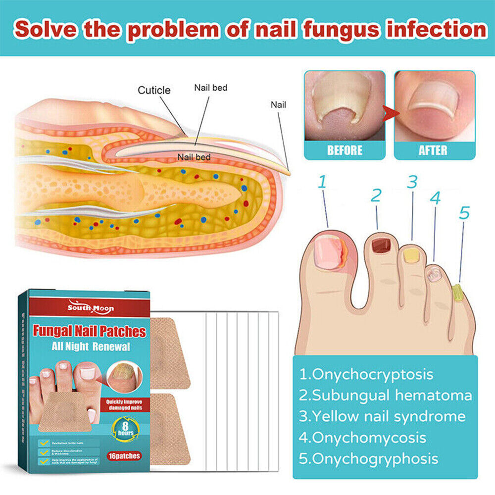 32pcs Nail Fungal Patches for Fungus Finger Toe Nail Repair Plaster Stickers