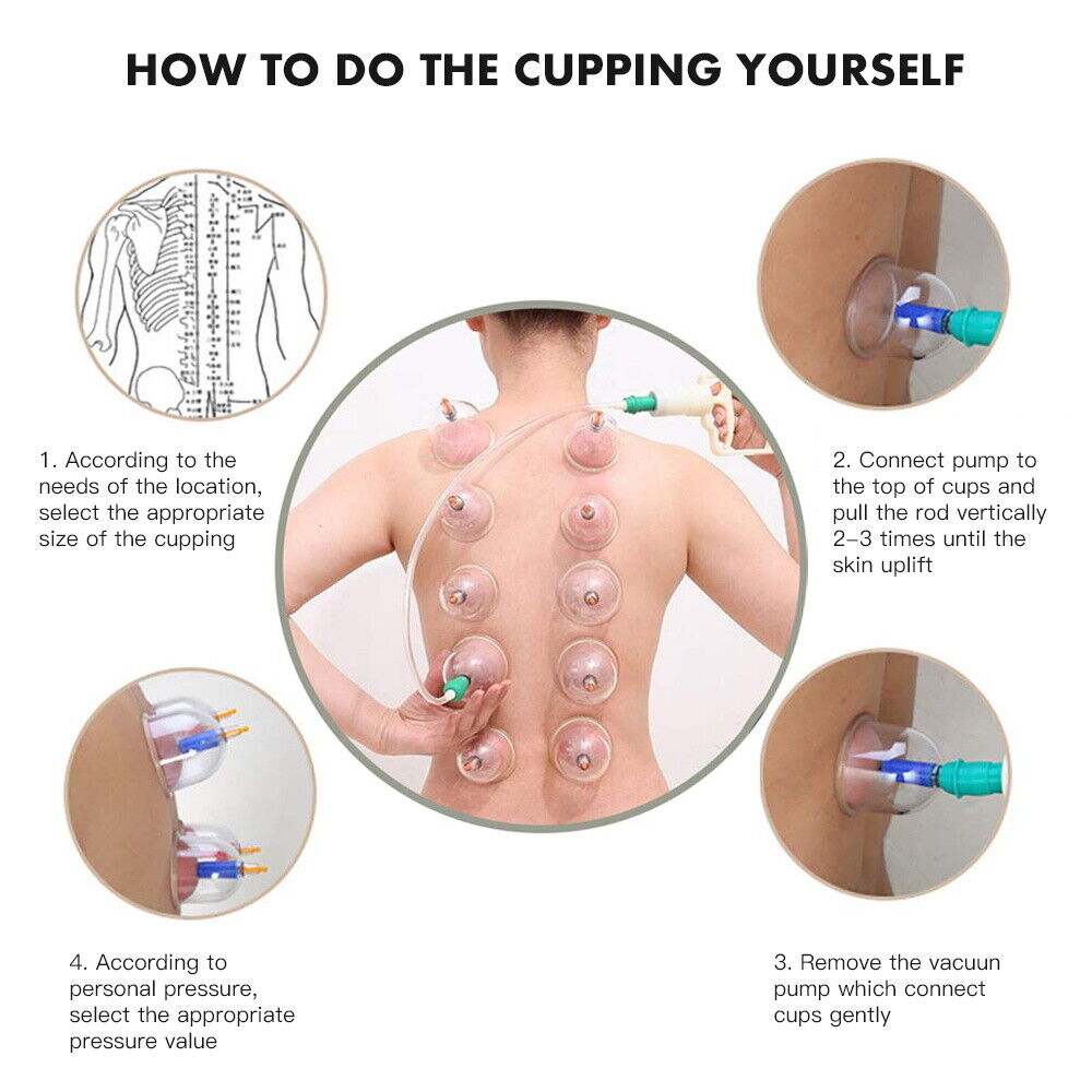 32 Cups Set Vacuum Cupping Suction Massager Kit Massage Acupuncture Pain Relief