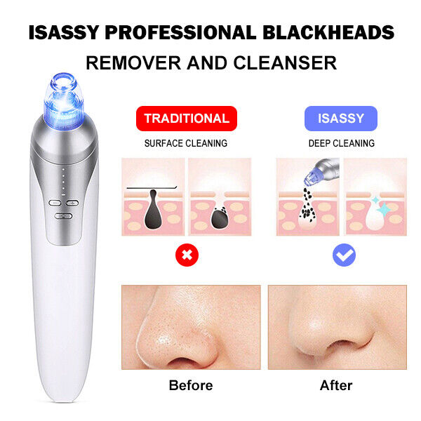 1 SET UBS Facial Blackhead Remover Vacuum Face Pore Pimple Suction Dermabrasion Tool