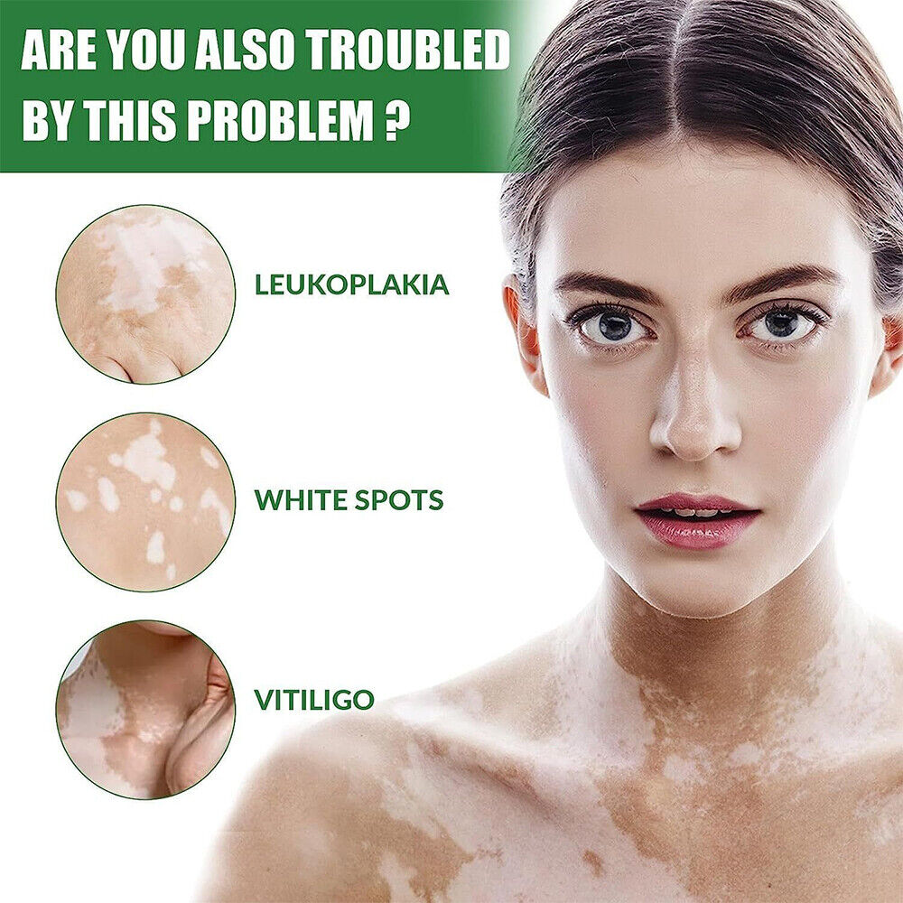 Vitiligo Fix Revitalize Elixir, Treatment Cream, Treat Vitiligo Soothing Cream