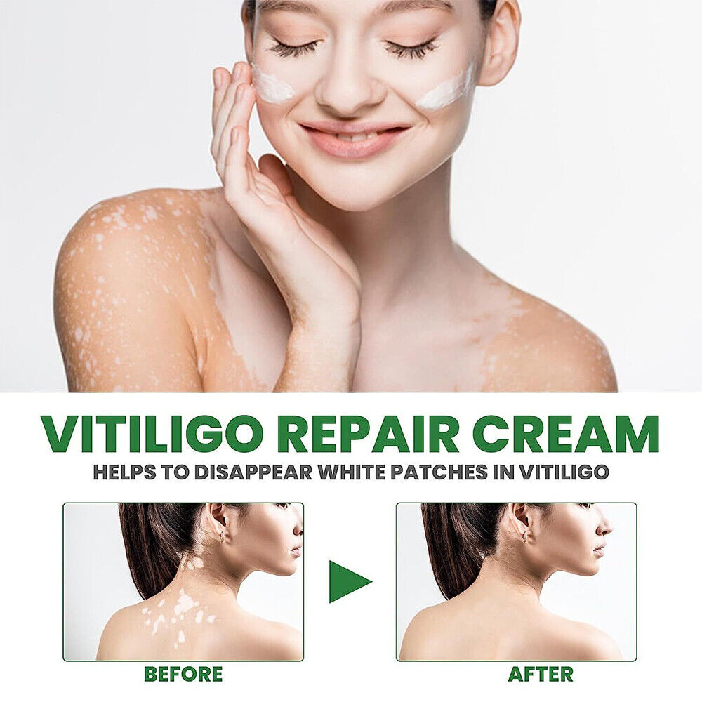 Vitiligo Fix Revitalize Elixir, Treatment Cream, Treat Vitiligo Soothing Cream