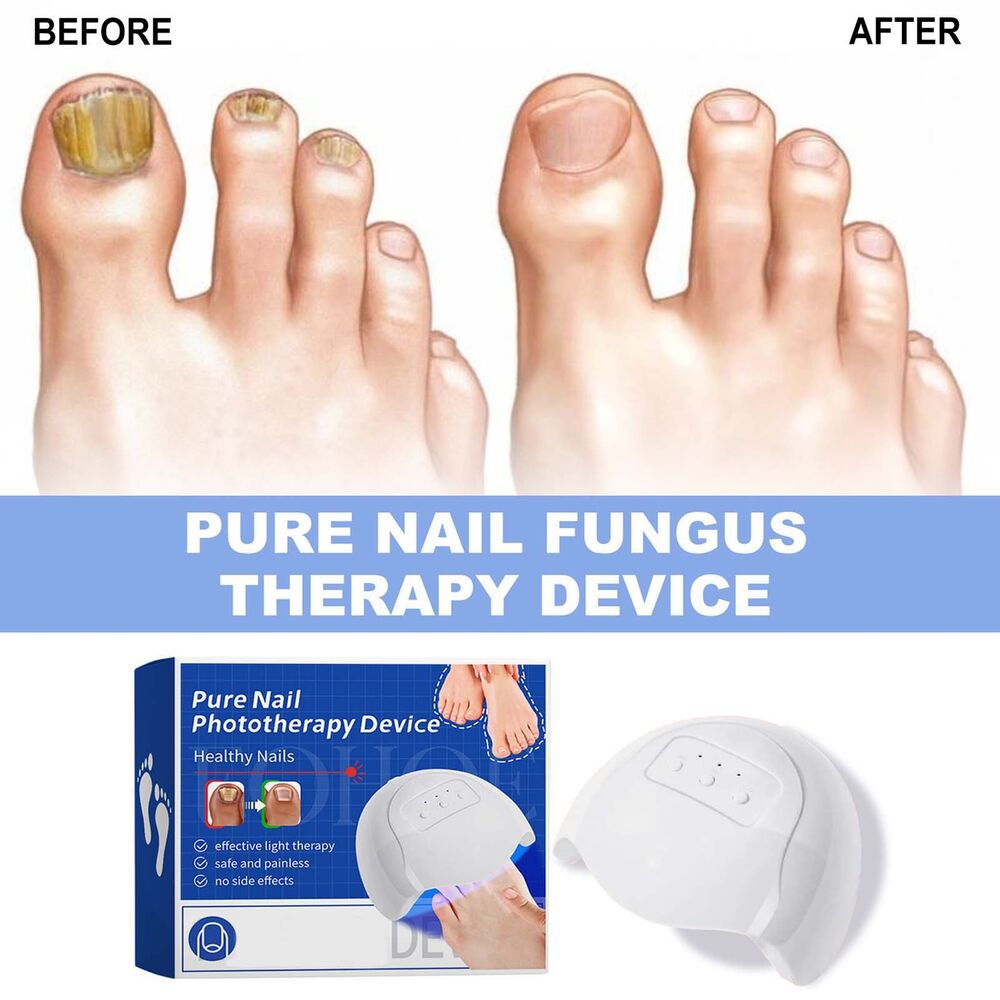 Nail Fungus Laser Device Light Therapy Onychomycosis Toes Treatment 910nm Home