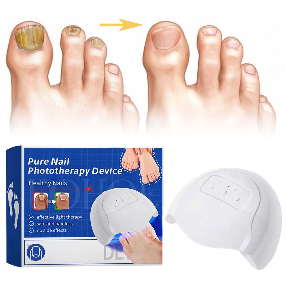 Nail Fungus Laser Device Light Therapy Onychomycosis Toes Treatment 910nm Home