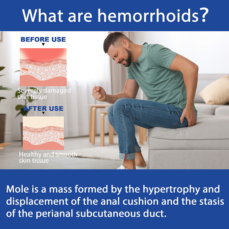 3 Hemorrhoid & Fissure Ointment Hemorrhoid Treatment