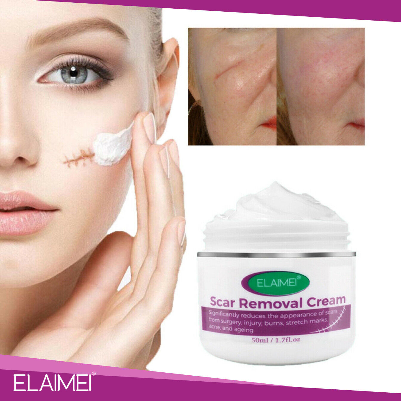 Scar Removal Treatment Cream Stretch Marks Skin Repair Advanced Face Body Heal