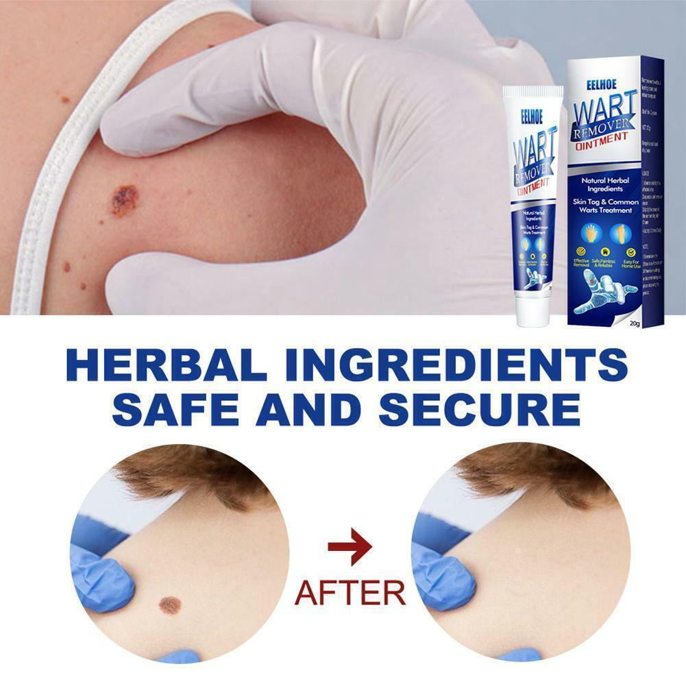 Instant Blemish Removal Gel Body Warts Remover Treatment Cream Skin Tag Care