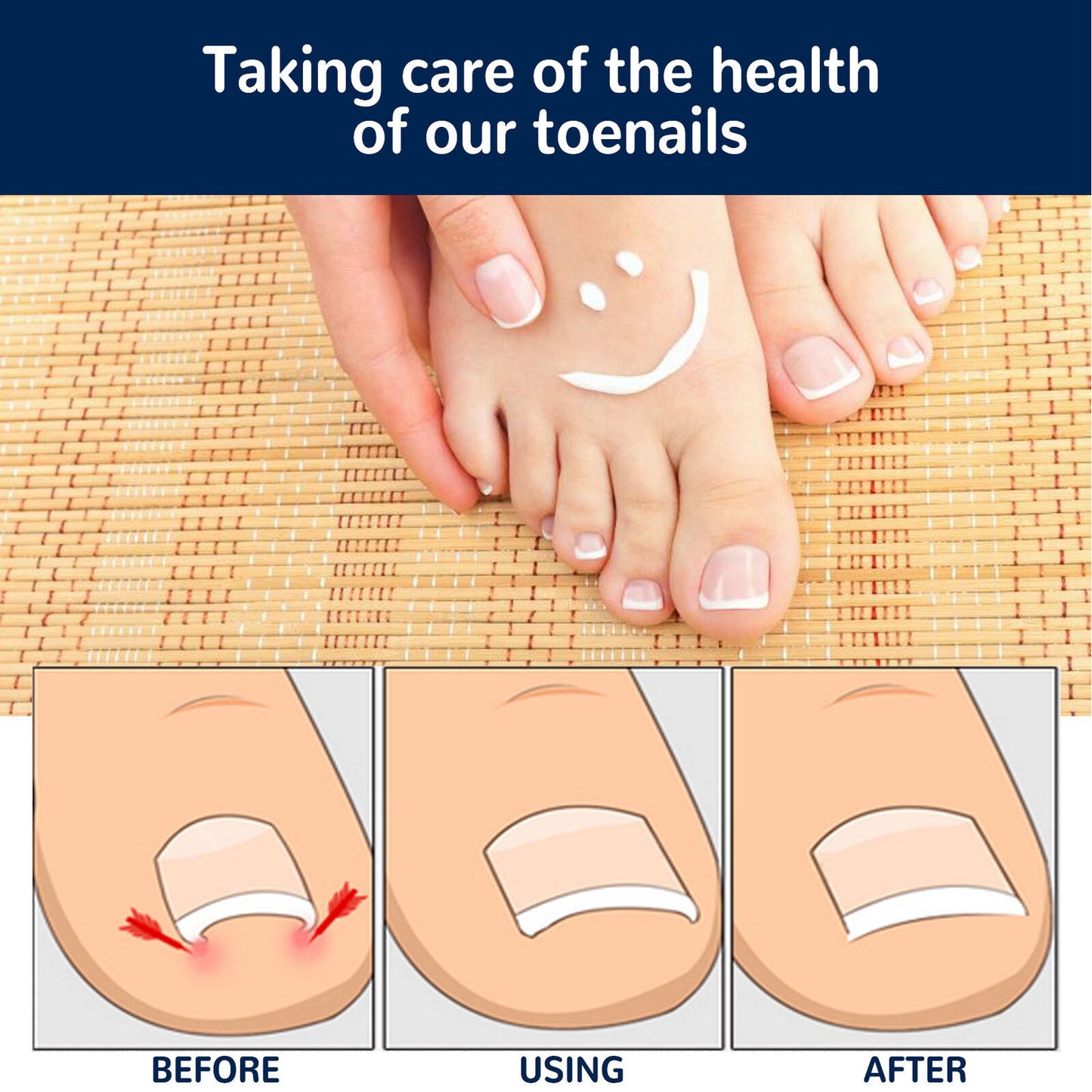 50x Ingrown Toenail Sticker Strong Adhesion Safe Easy To Use Toenail SLS