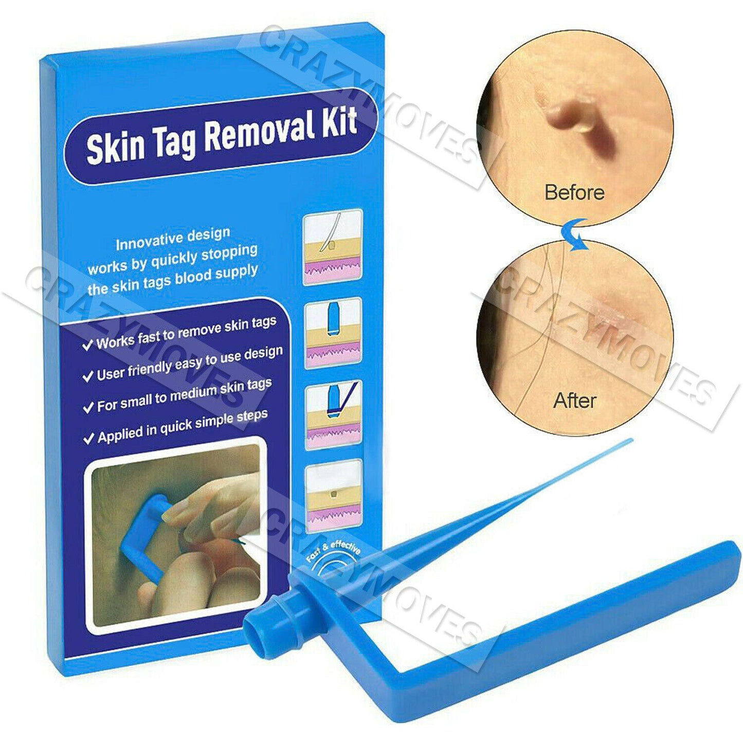 Skin Tag Remover Kit for Fast & Effective Skin Tag Removal VIC