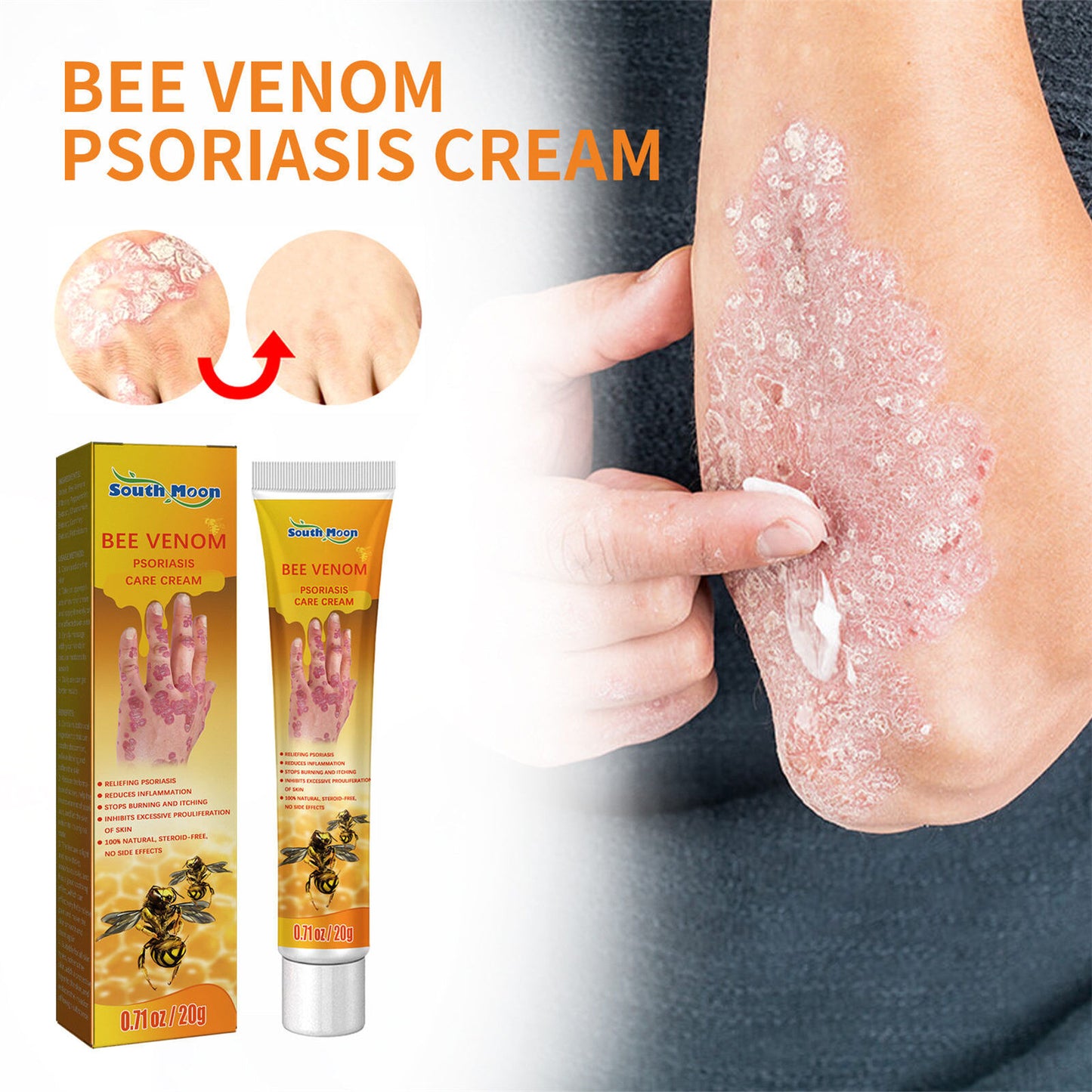 Bee Venom Psoriasis Cream Dermatitis Eczema Ointment Healing Antibacterial Cream