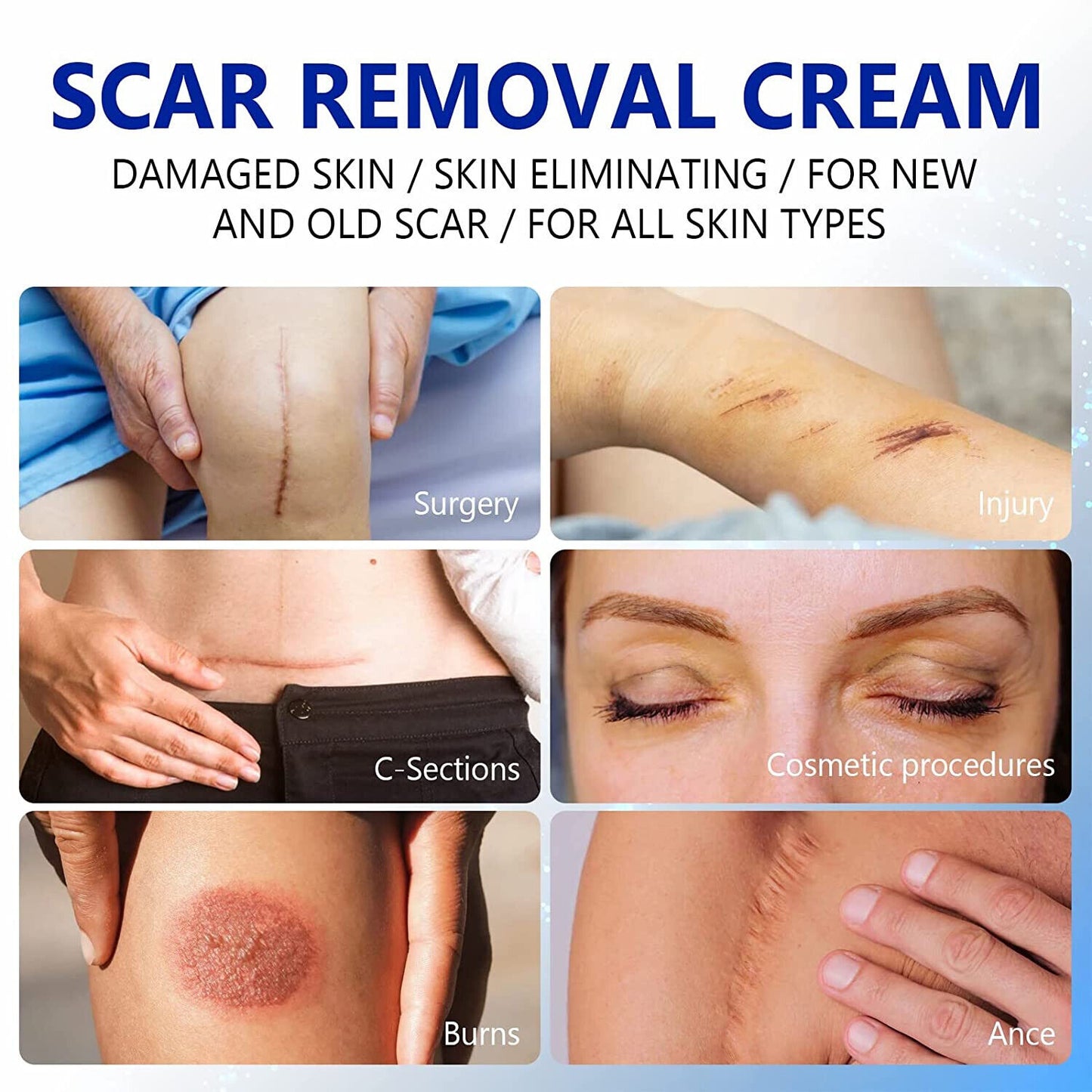 Scar Removal Cream Advanced Scar Treatment Gel Stretch Marks Acne Skin Repair