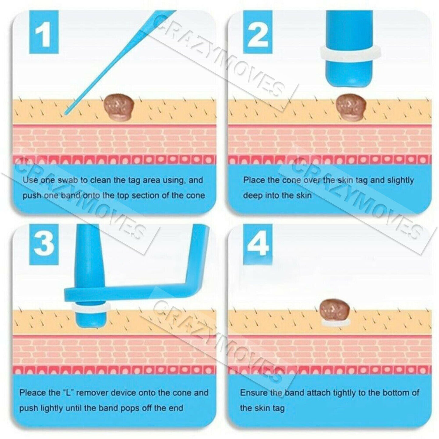 Skin Tag Remover Kit for Fast & Effective Skin Tag Removal VIC