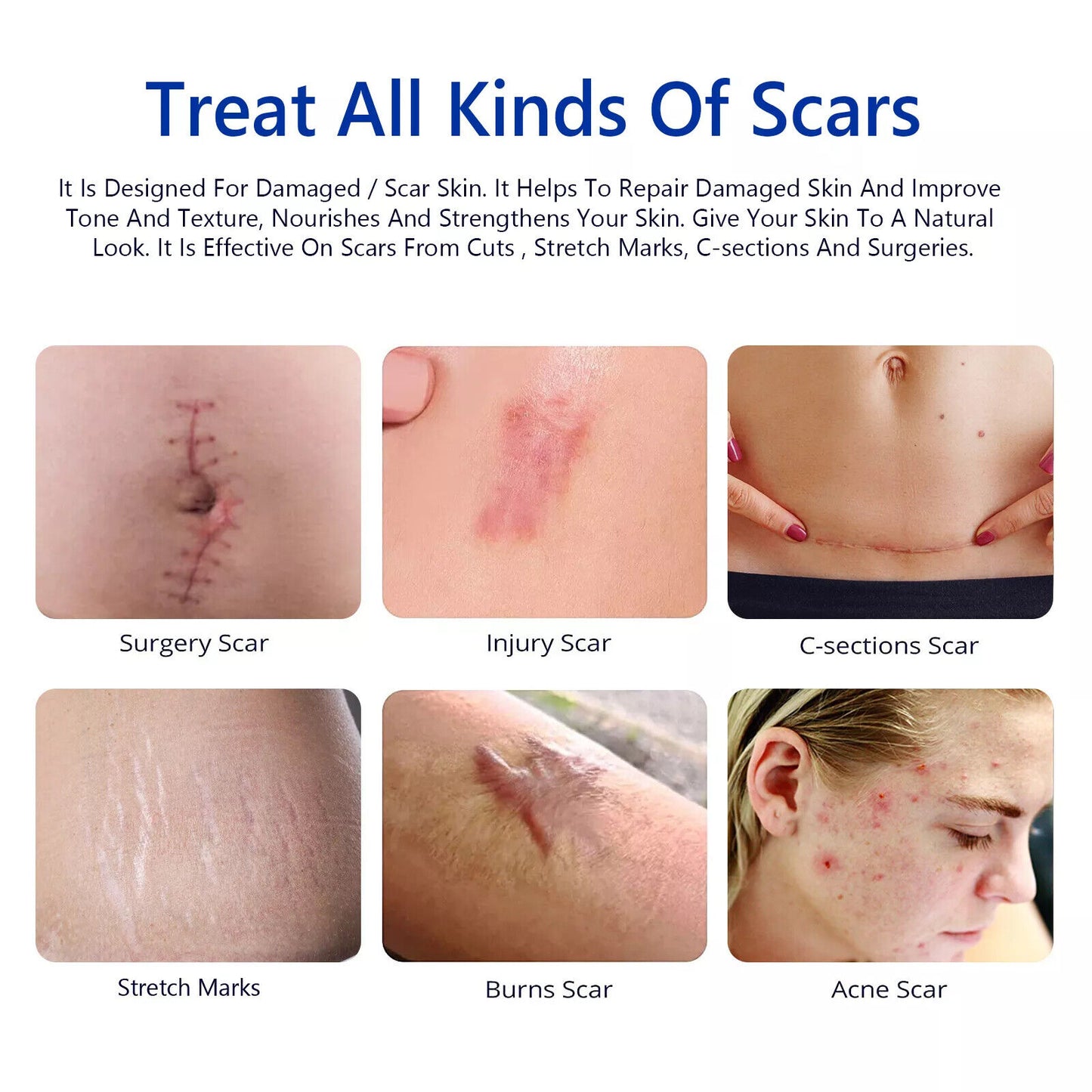 Scar Removal Cream Advanced Scar Treatment Gel Stretch Marks Acne Skin Repair