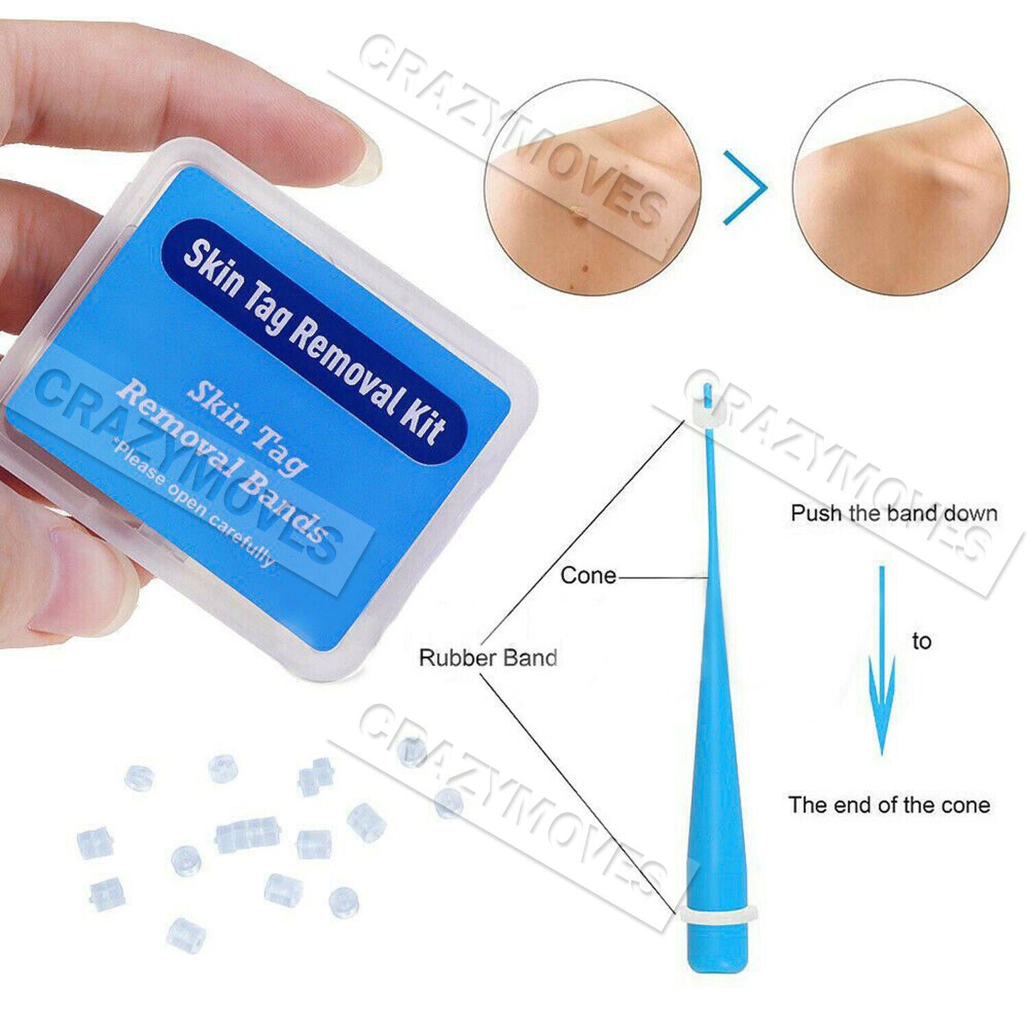 Skin Tag Remover Kit for Fast & Effective Skin Tag Removal VIC