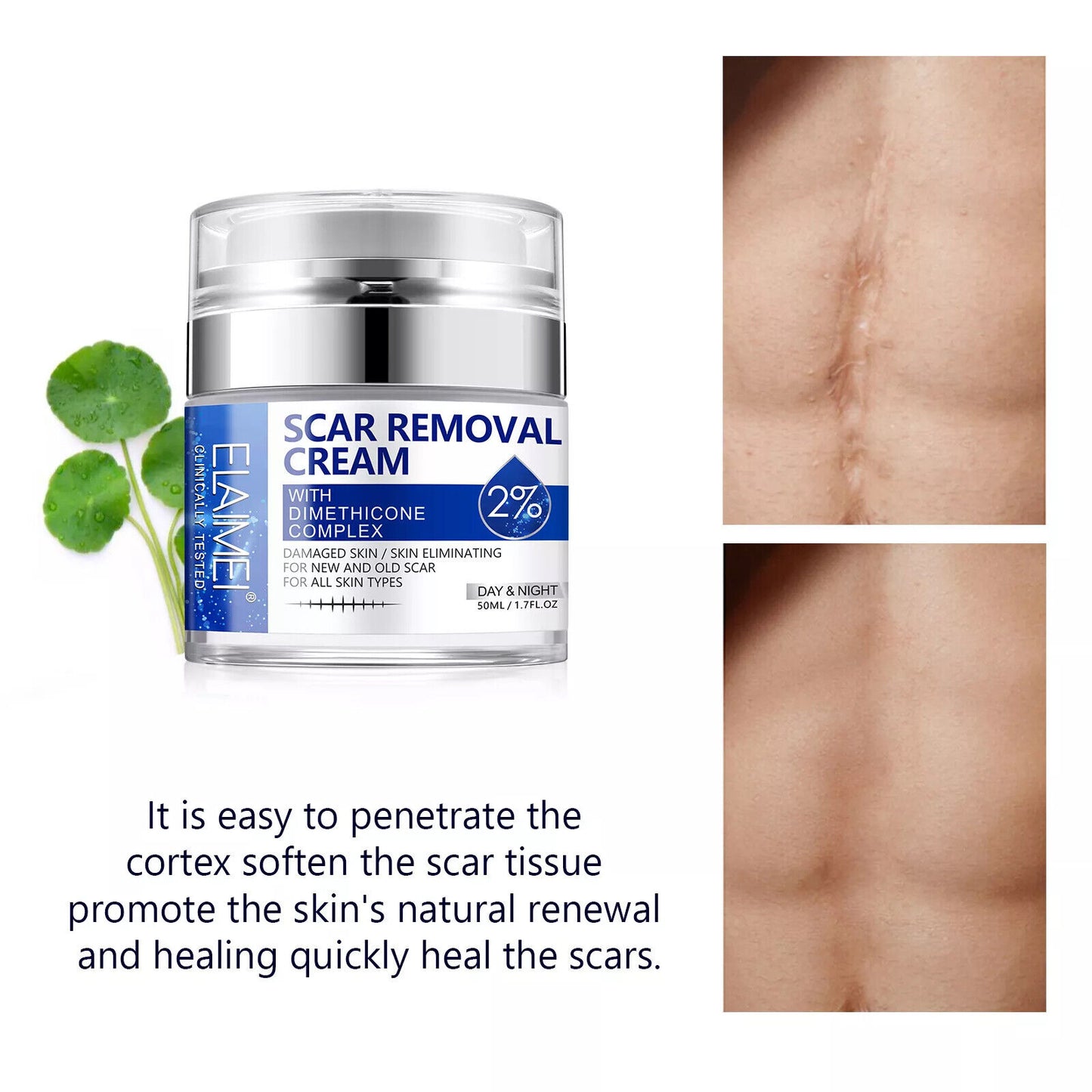 Scar Removal Cream Advanced Scar Treatment Gel Stretch Marks Acne Skin Repair