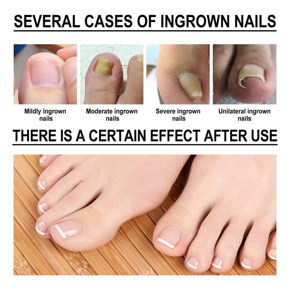 Ingrown Toenail Treatment Serum Nail Correction Recover Oil Pain Reliever