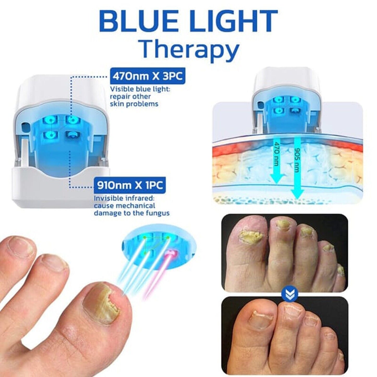 Nail Fungus Laser Device Light Therapy Onychomycosis Toes Treatment HOT