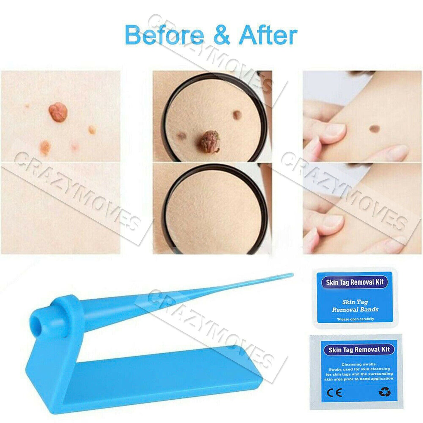 Skin Tag Remover Kit for Fast & Effective Skin Tag Removal VIC