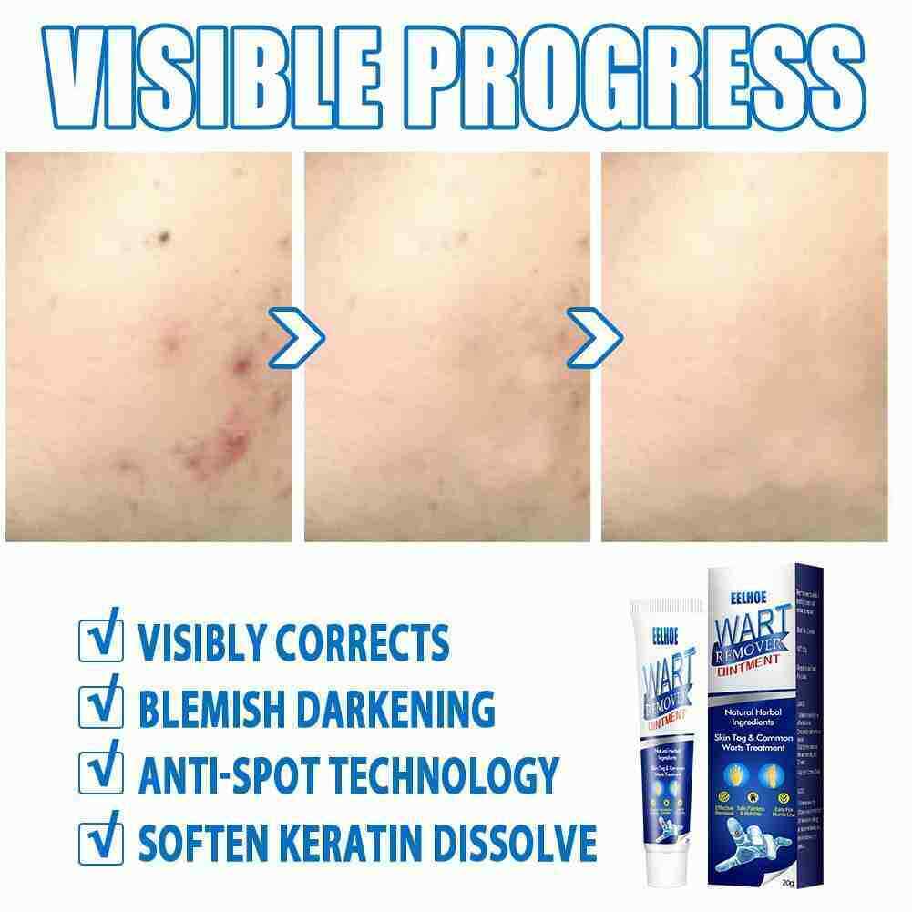 Instant Blemish Removal Gel Body Warts Remover Treatment Cream Skin Tag Care