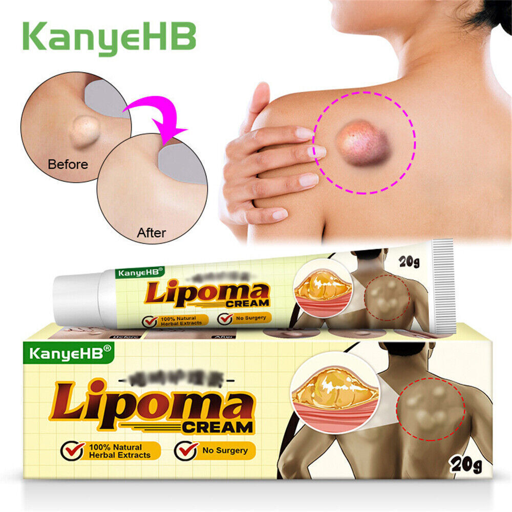 Lipoma Removal Cream Treatment Skin Swelling Ointment Exfoliating Pain Relief`