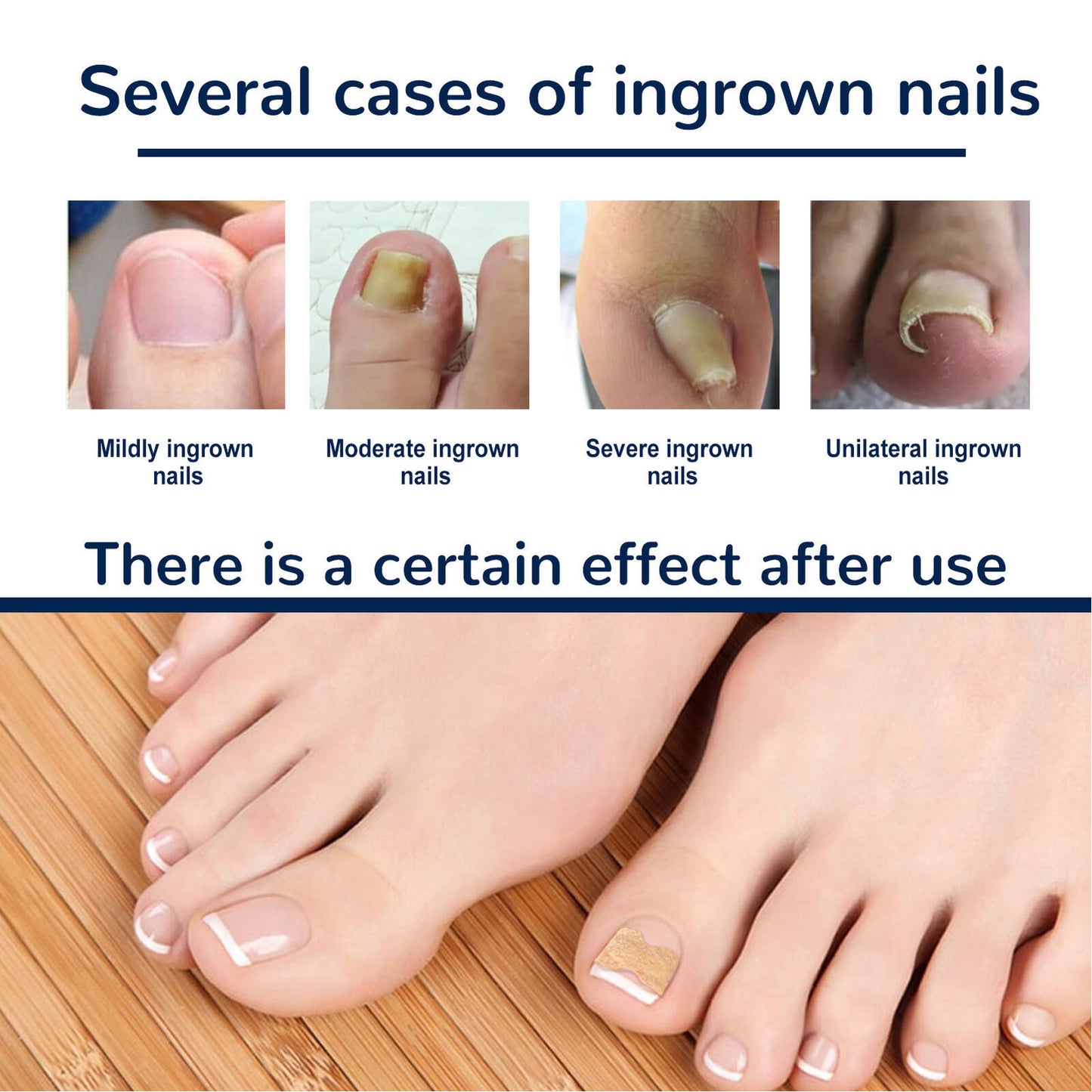 50x Ingrown Toenail Sticker Strong Adhesion Safe Easy To Use Toenail SLS