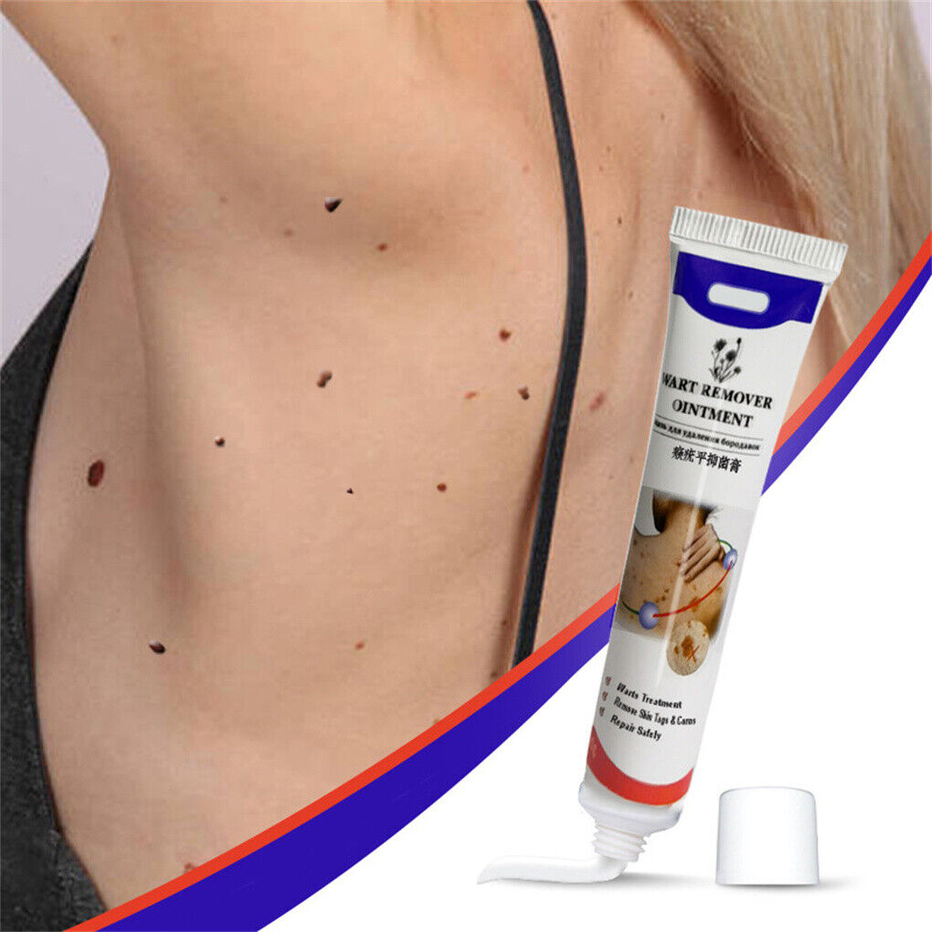 Wart Removal Treatment Cream Body Warts Treatment Cream Skin Tag Remover